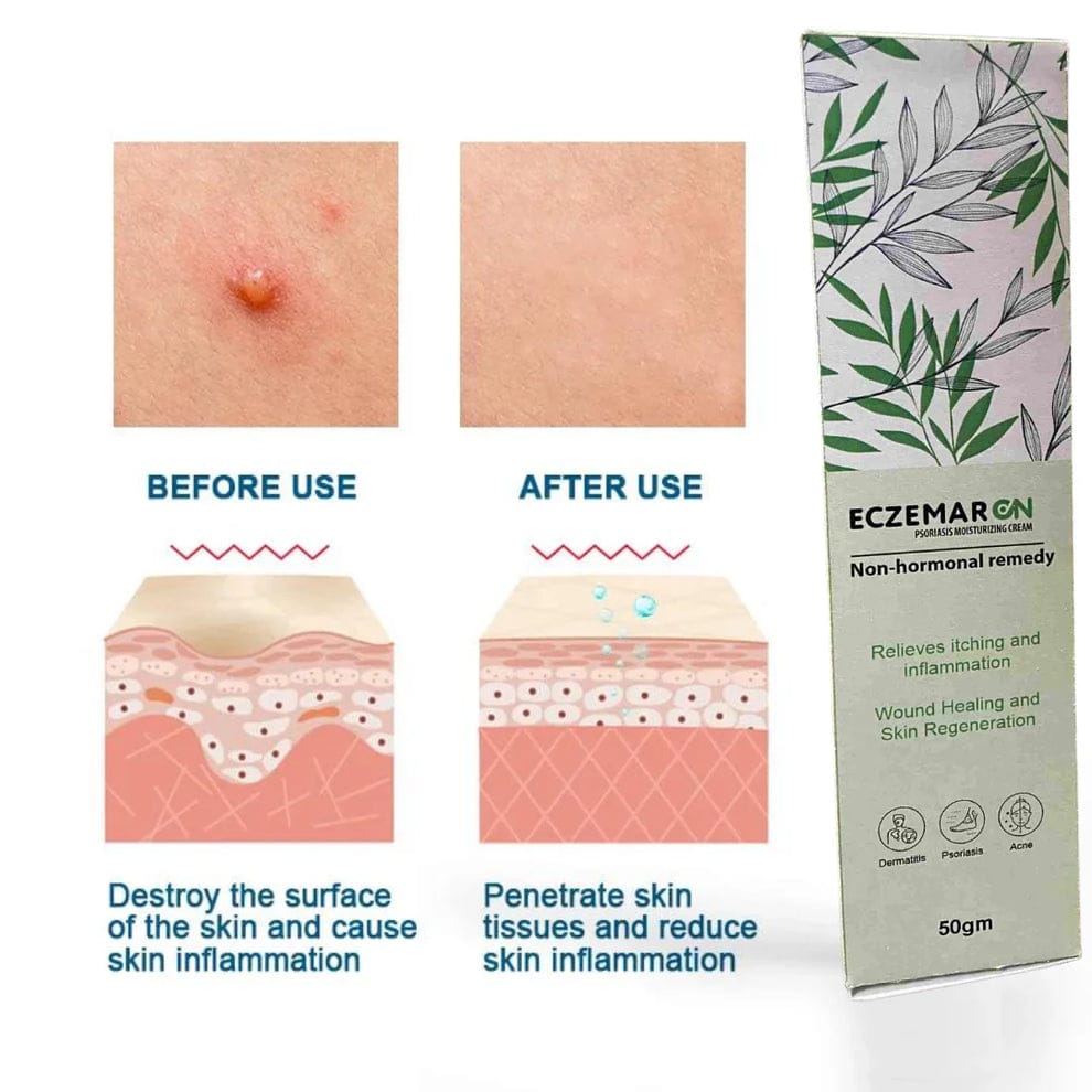 ECZEMARON ANTI - FUNGAL SPRAY - Doctor's  Recommended  👨🏽⚕️(Buy 1 Get 1 Free🔥🔥)(4.9/5.0⭐⭐⭐⭐⭐)