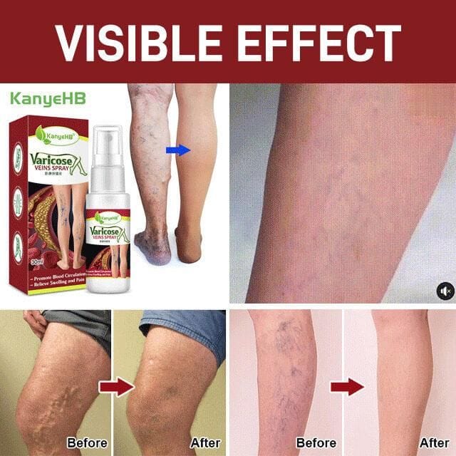 Varicose Veins Treatment Spray (🔥🔥buy 1 get 1 free🔥🔥)