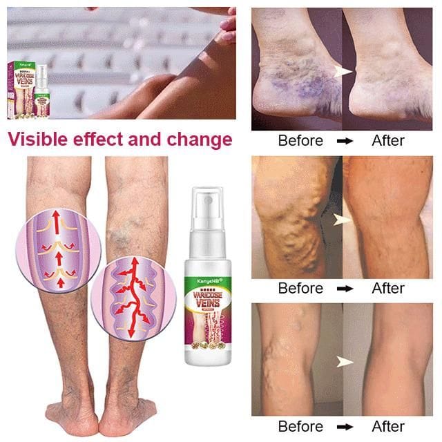 Varicose Veins Treatment Spray (🔥🔥buy 1 get 1 free🔥🔥)
