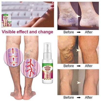 Varicose Veins Treatment Spray (🔥🔥buy 1 get 1 free🔥🔥)